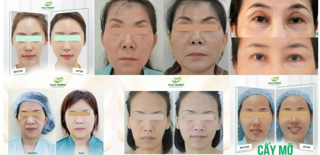 PRP kết hợp mỡ tự thân – Bí quyết trẻ hóa da từ sâu bên trong.