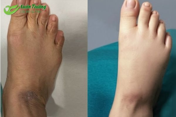 Bàn chân trước và sau khi cấy mỡ – hiệu quả rõ rệt.