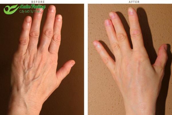 Cấy mỡ bàn tay không chỉ xóa nhăn, làm đầy mà còn cải thiện độ đàn hồi của da