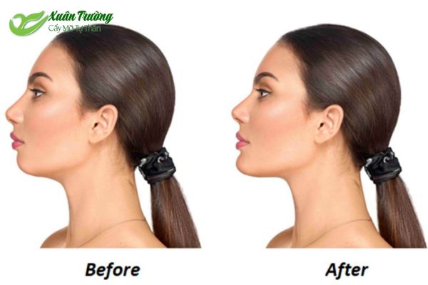 Cằm hài hòa, thon gọn nhờ cấy mỡ tự nhiên.