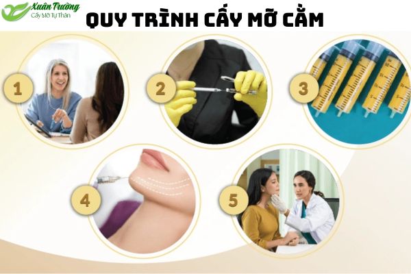 Các bước chi tiết trong quy trình cấy mỡ cằm.