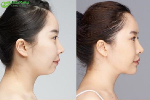 Khuôn mặt cân đối hơn sau khi cấy mỡ cằm.