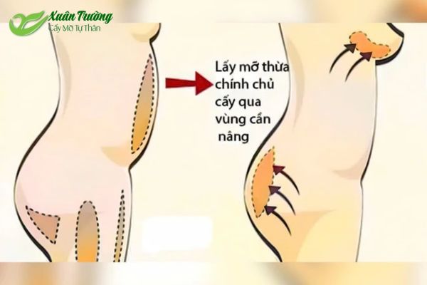 Vùng ngực được cải thiện bằng mỡ tự thân