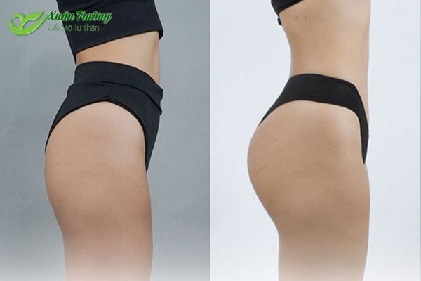 Kết quả nâng mông tự nhiên sau khi cấy mỡ