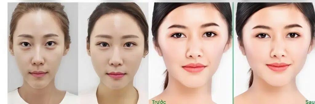 Cấy mỡ kết hợp PRP tại Thẩm mỹ Xuân Trường – Khuôn mặt trẻ trung, căng mịn chỉ sau 1 liệu trình.