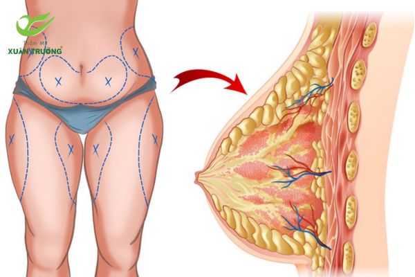 Cấy mỡ ngực giúp bạn sở hữu vòng một mềm mại, tự nhiên