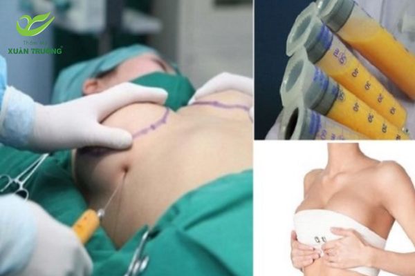 Giải pháp thẩm mỹ an toàn, tự nhiên, không để lại sẹo lớn.