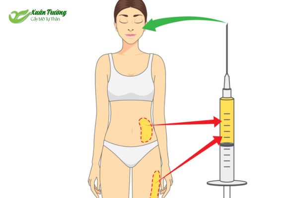Lấy mỡ tự thân từ vùng bụng hoặc đùi của khách hàng.