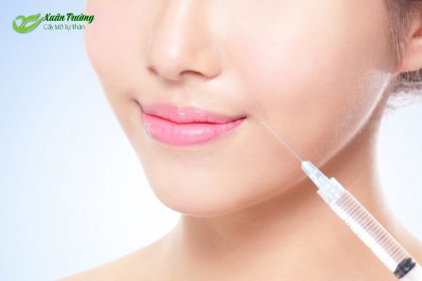 Tiêm mỡ đã xử lý vào vùng rãnh cười chính xác.