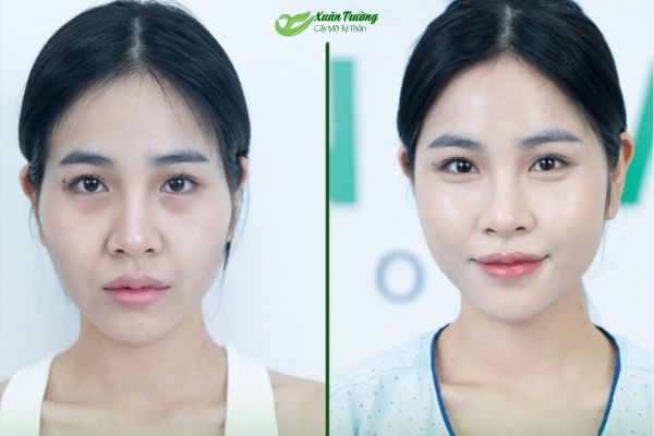  Vùng thái dương trước và sau cấy mỡ