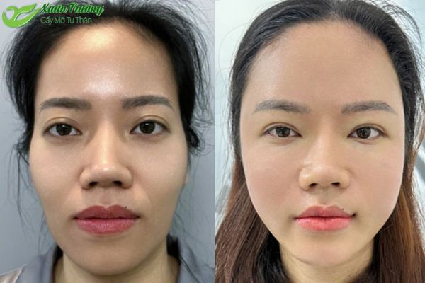 Mô phỏng cấu trúc khuôn mặt trước và sau cấy mỡ