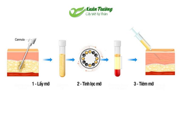 Quy trình ba bước: lấy – xử lý – cấy mỡ