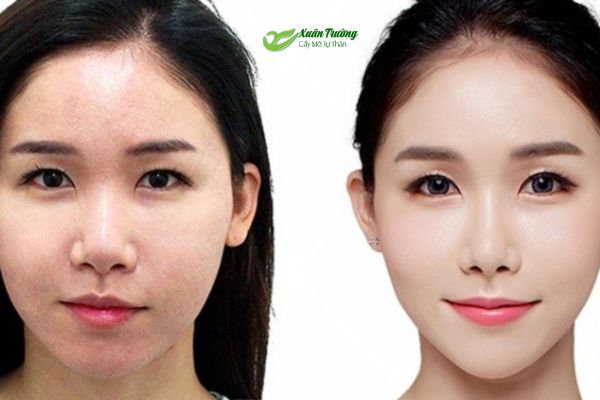 Cấy mỡ toàn mặt giúp da căng bóng, đường nét gương mặt thêm hài hòa.