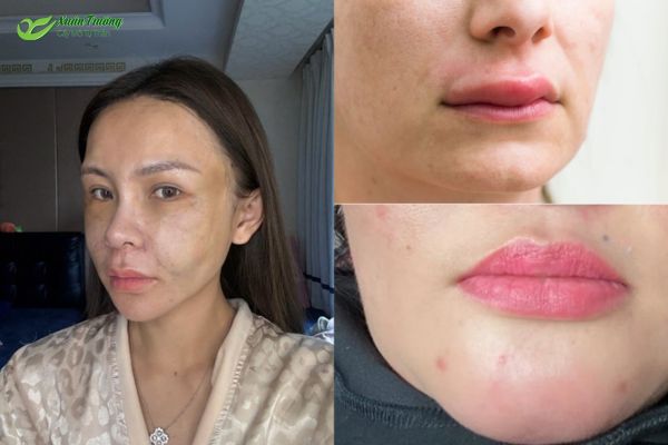 Một số phản ứng như sưng đỏ sau khi cấy mỡ.