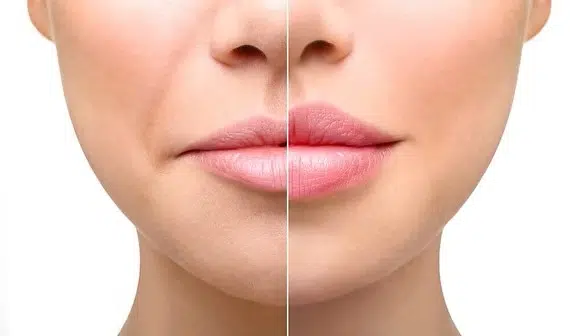 Cay mo lam day ranh cuoi