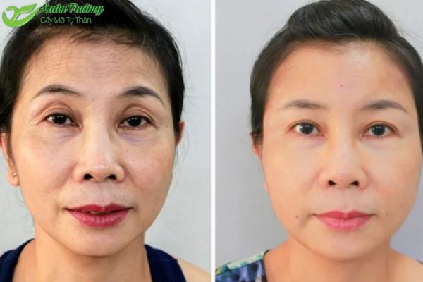 Cải thiện nếp nhăn và quầng thâm vùng mắt hiệu quả