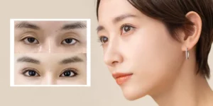 Cấy mỡ hốc mắt bao lâu thì ổn định