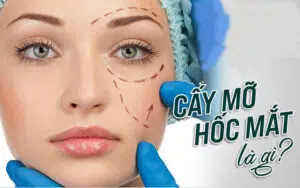 Cấy mỡ hốc mắt được bao lâu