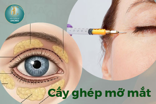 Cấy mỡ hốc mắt được bao lâu? - Bí quyết trẻ hóa đôi mắt tự nhiên và bền lâu