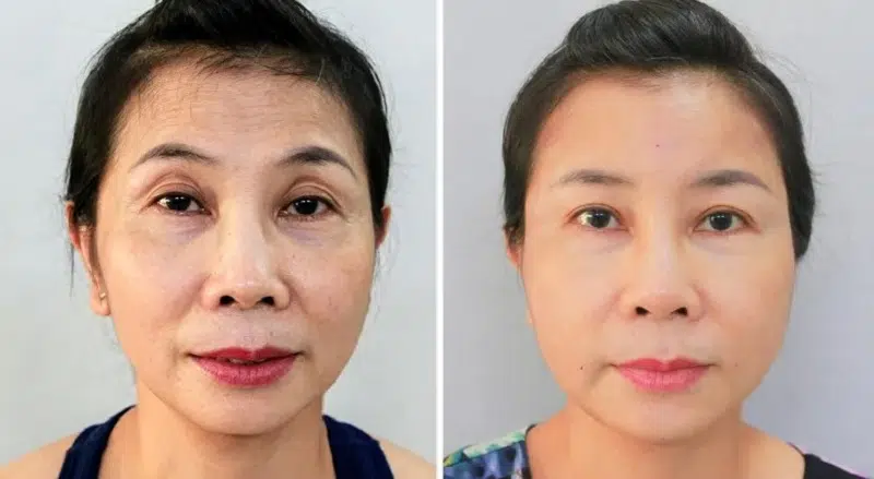 Cấy mỡ hốc mắt giá bao nhiêu