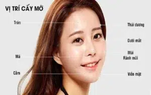 Cấy mỡ mã bao nhiêu tiền