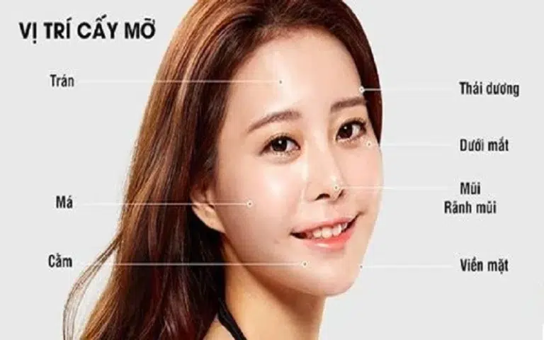 Cấy mỡ mã bao nhiêu tiền