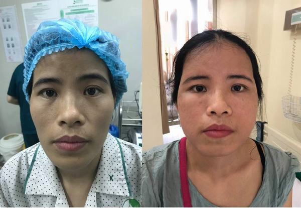 Cấy mỡ má bao nhiêu tiền – Bí quyết nâng cao vẻ đẹp tự nhiên và an toàn