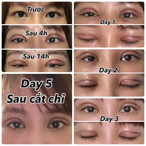 Cấy Mỡ Mặt Bao Lâu Hết Sưng - Bí Quyết Đánh Giá Thời Gian Phục Hồi Và Chi Phí
