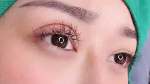 Cấy mỡ mí mắt dưới giá bao nhiêu