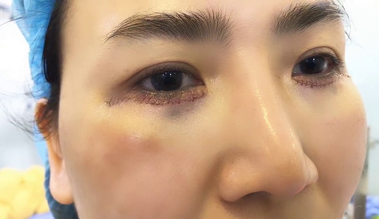 Cấy Mỡ mí Mắt Dưới Giá Bao Nhiêu? - Bí Quyết Đẹp Tự Nhiên Và An Toàn