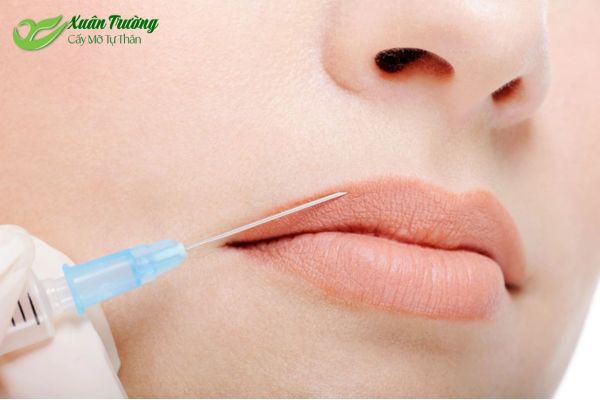Tiêm mỡ tự thân giúp môi đầy đặn tự nhiên