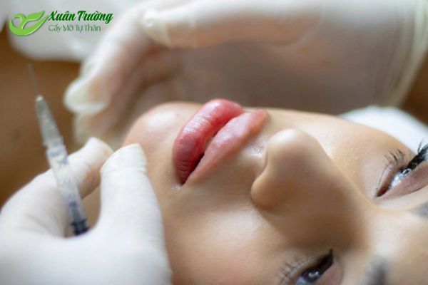 Phương pháp cấy mỡ môi an toàn, bài bản, hiệu quả.