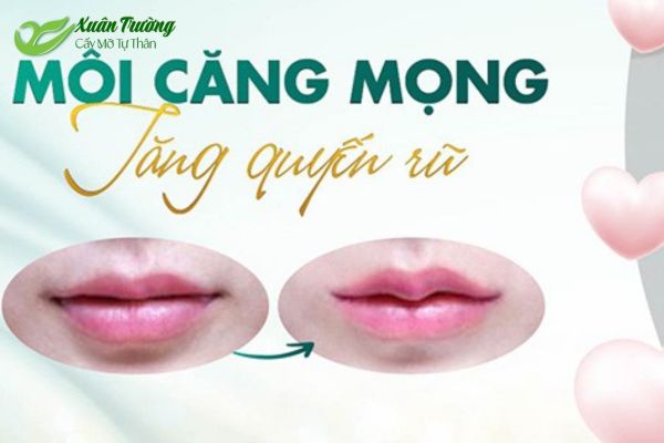 Cấy mỡ môi giúp môi mềm mại, quyến rũ và tự nhiên hơn