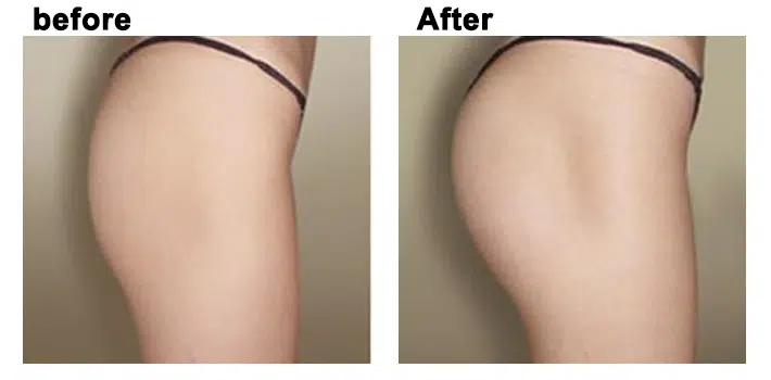 Cấy mỡ mông bằng mỡ tự thân