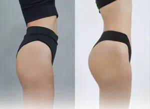 Cấy mỡ mông giữ được hiệu quả từ 5 – 10 năm