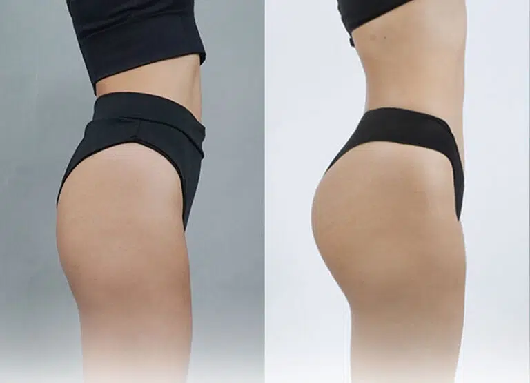 Cấy mỡ mông giữ được hiệu quả từ 5 – 10 năm