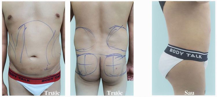Cấy Mỡ Mông Giữ Được Bao Lâu? Bí Quyết Tăng Vòng 3 Hiệu Quả Và An Toàn