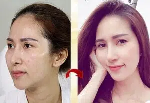 Cấy mỡ thái dương giá bao nhiêu