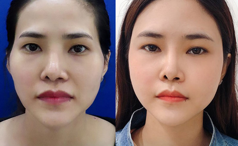 Cấy Mỡ Thái Dương Giá Bao Nhiêu - Giải Pháp Làm Đẹp Tối Ưu Cho Quầng Thâm Và Vẻ Đẹp Thanh Xuân