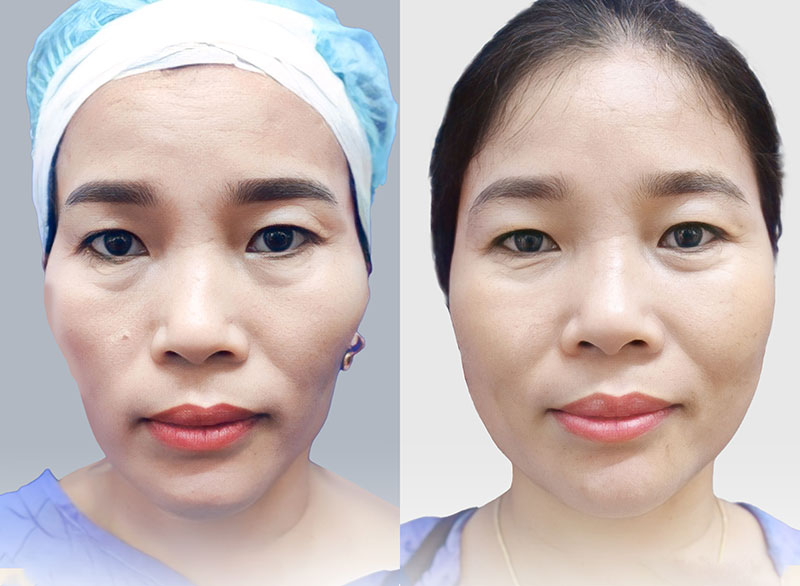 Cấy Mỡ Thái Dương Giá Bao Nhiêu - Giải Pháp Làm Đẹp Tối Ưu Cho Quầng Thâm Và Vẻ Đẹp Thanh Xuân