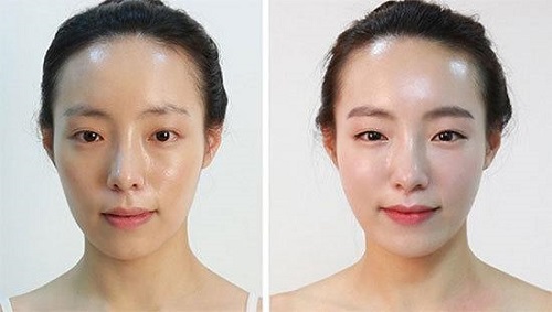 Cấy Mỡ Thái Dương Giá Bao Nhiêu - Giải Pháp Làm Đẹp Tối Ưu Cho Quầng Thâm Và Vẻ Đẹp Thanh Xuân