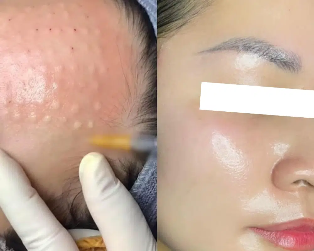 So sánh kết quả của tiêm prp và cấy mỡ tự thân