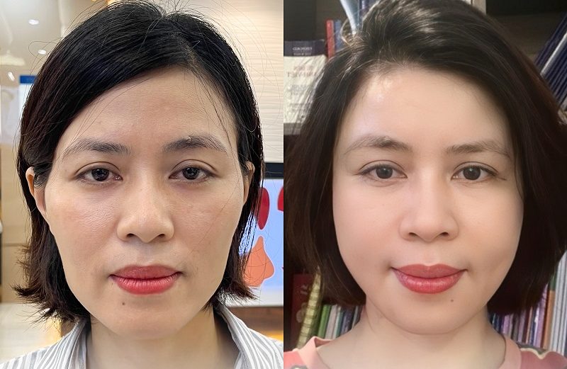 Cấy mỡ giá bao nhiêu - Bí quyết làm đẹp tự nhiên và an toàn cho phái đẹp
