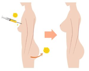 Cấy mỡ tự thân ở đâu tốt