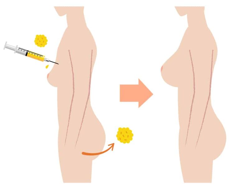 Cấy mỡ tự thân ở đâu tốt
