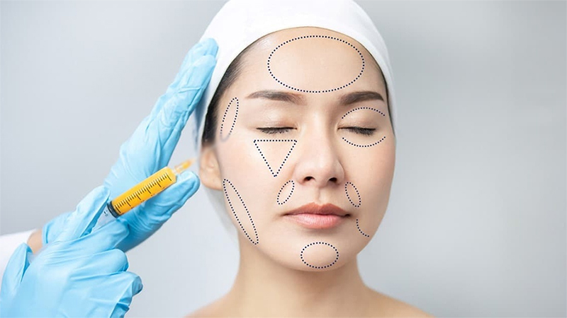 Cấy mỡ tự thân ở đâu tốt - Giải pháp làm đẹp an toàn, hiệu quả cao