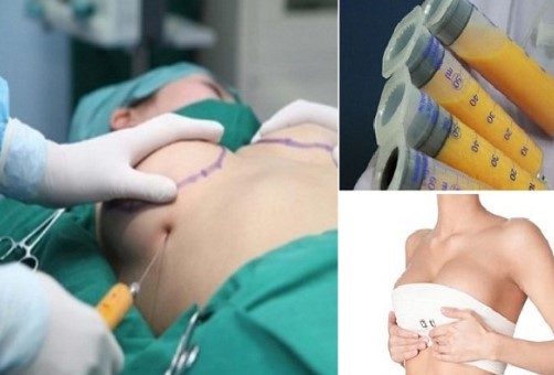 Cấy mỡ tự thân ở đâu tốt - Giải pháp làm đẹp an toàn, hiệu quả cao