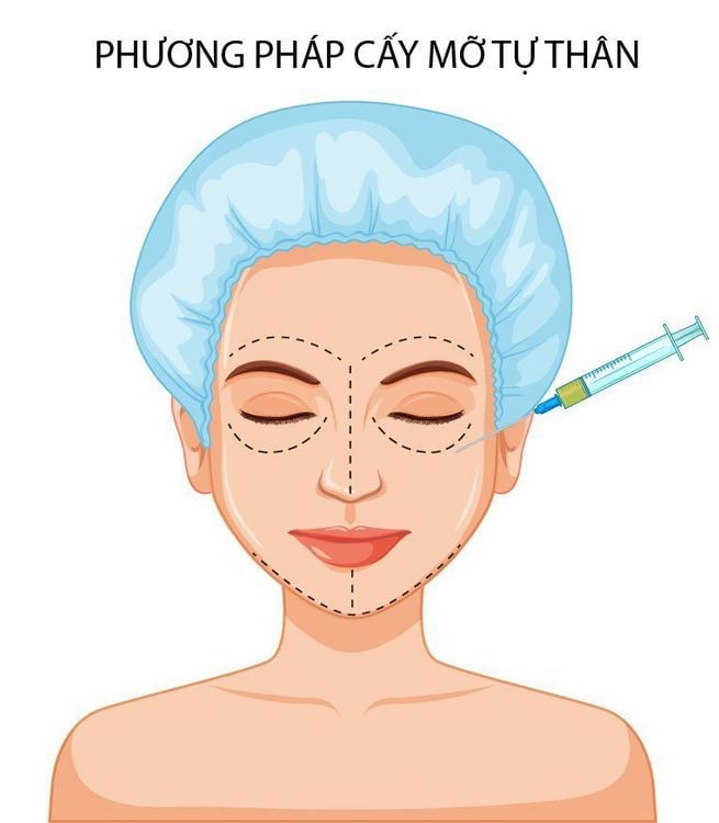 Cấy mỡ tự thân ở đâu tốt - Giải pháp làm đẹp an toàn, hiệu quả cao