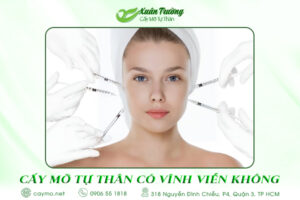 Cấy mỡ tự thân có được vĩnh viễn không