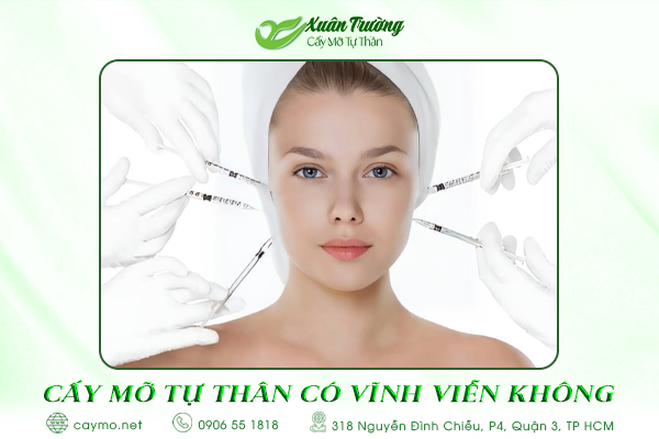 Cấy mỡ tự thân có được vĩnh viễn không